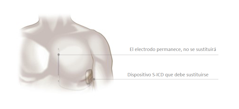 Es necesario reemplazar el dispositivo s-icd