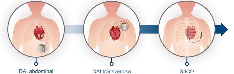 Ilustración del S-ICD frente a los DAI tradicionales
