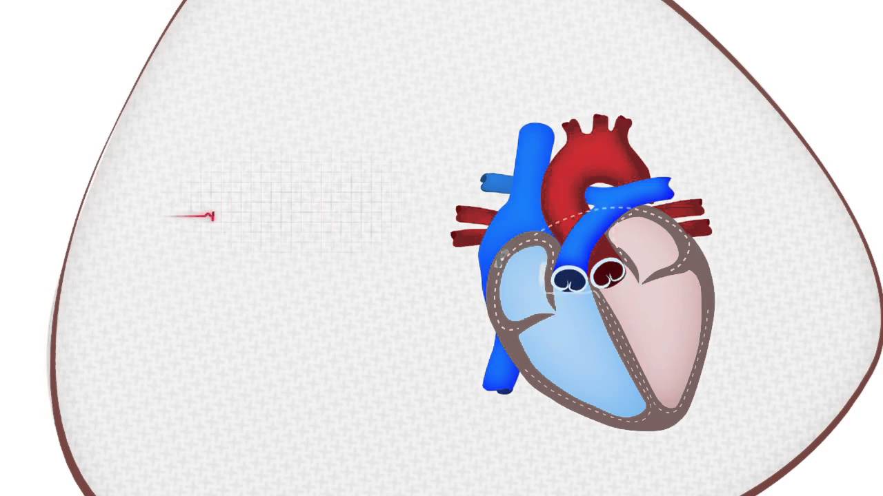 Explicación sobre el Paro Cardiorrespiratorio (PCR)